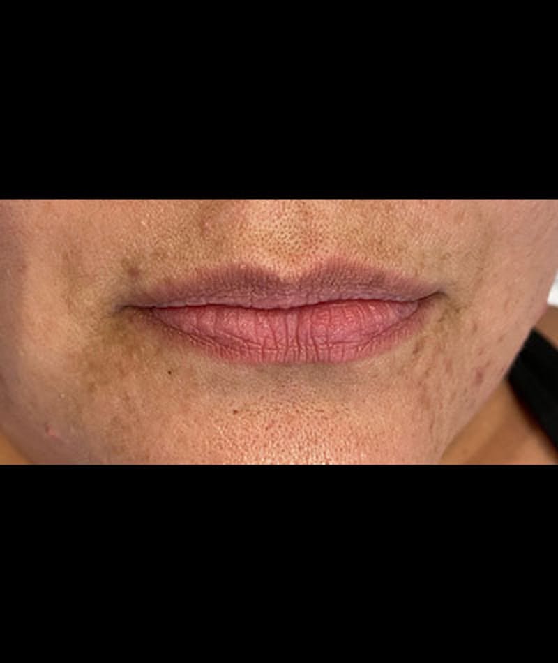 Fillers Before & After Gallery - Patient 108443256 - Image 1