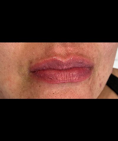 Fillers Before & After Gallery - Patient 108443256 - Image 2
