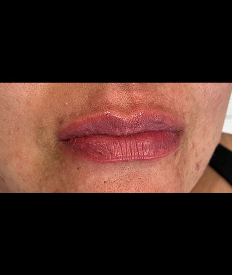 Fillers Before & After Gallery - Patient 108443256 - Image 2