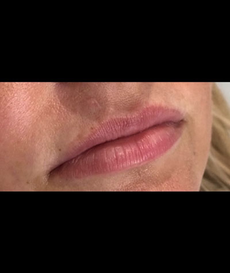 Fillers Before & After Gallery - Patient 108443261 - Image 1