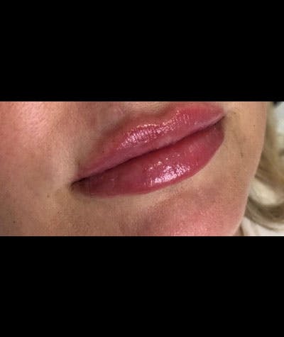 Fillers Before & After Gallery - Patient 108443261 - Image 2