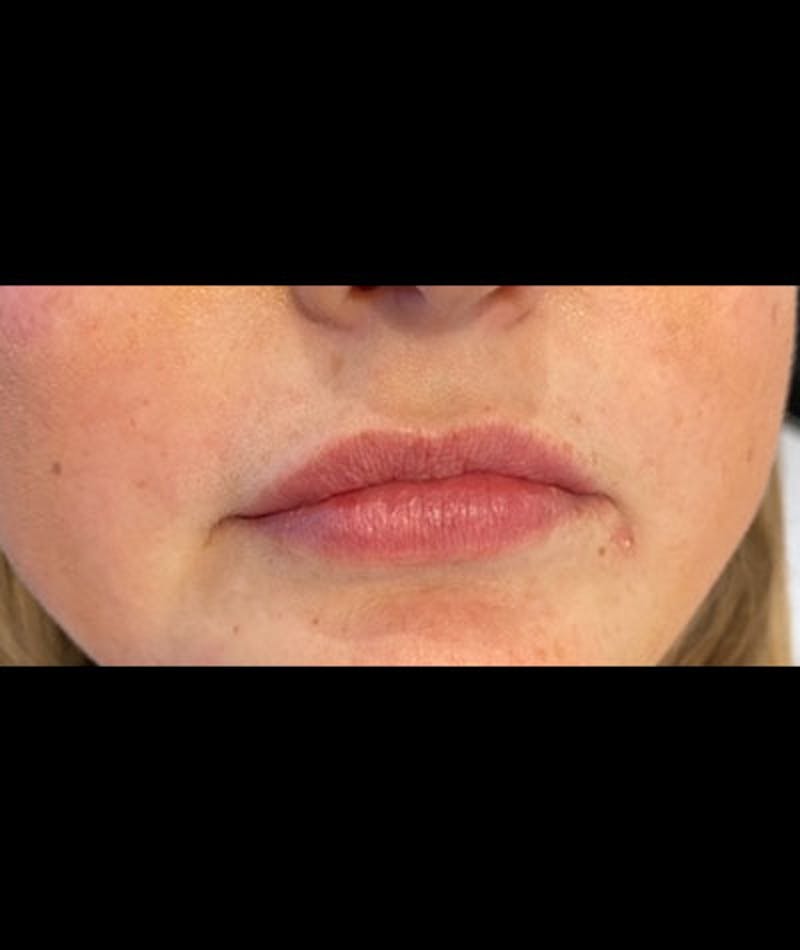 Fillers Before & After Gallery - Patient 108443265 - Image 1