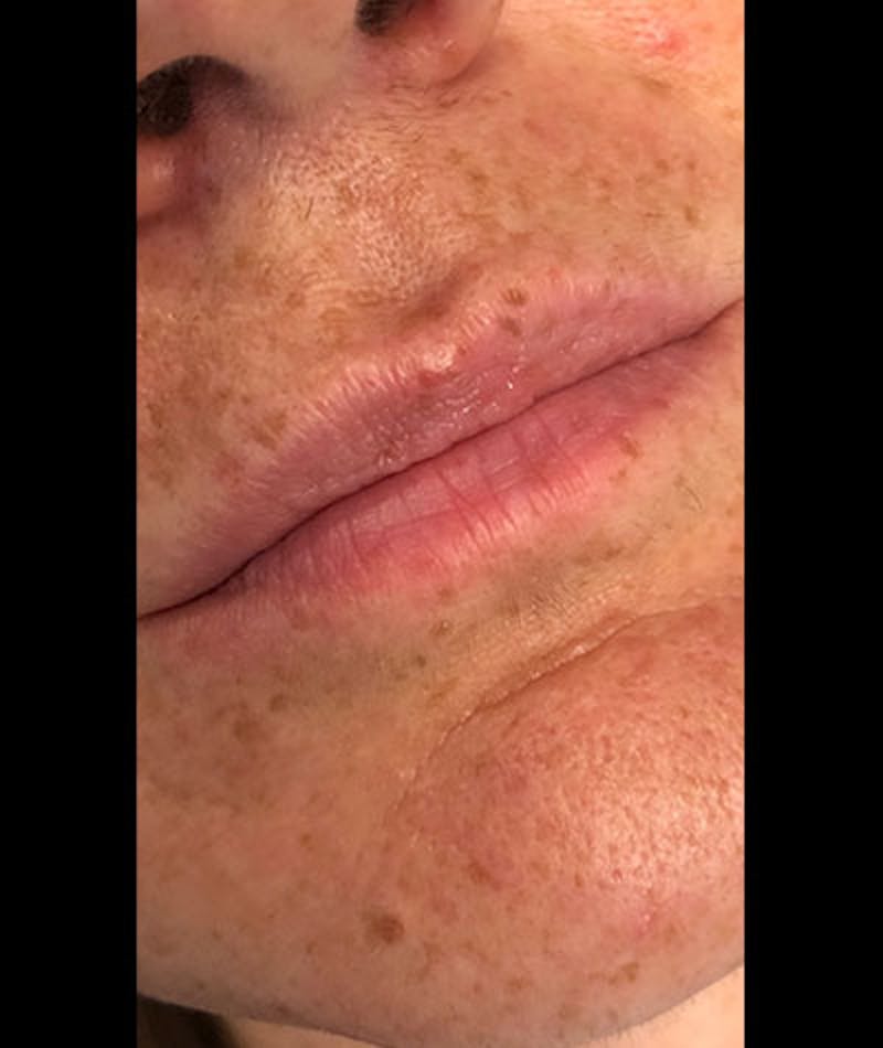 Fillers Before & After Gallery - Patient 108443268 - Image 1