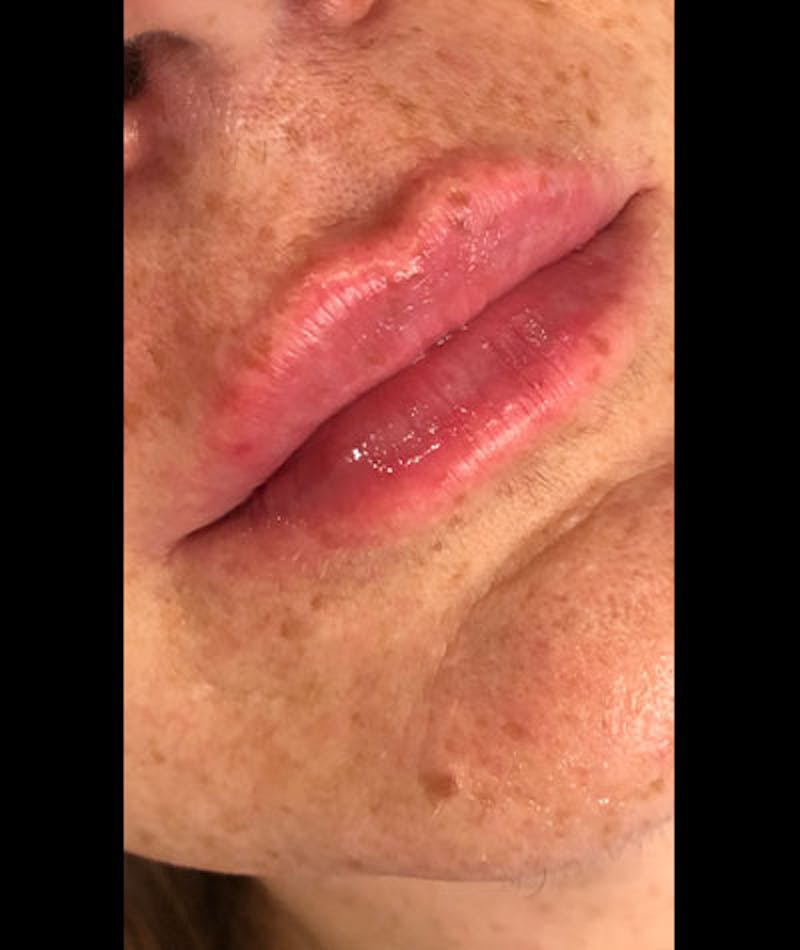 Fillers Before & After Gallery - Patient 108443268 - Image 2