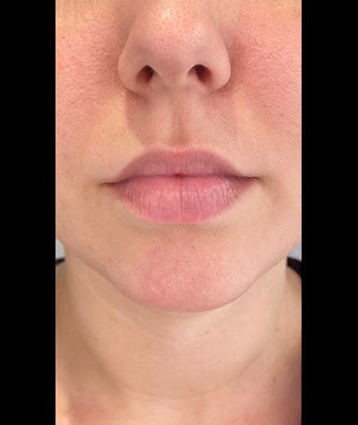 Fillers Before & After Gallery - Patient 108443274 - Image 1