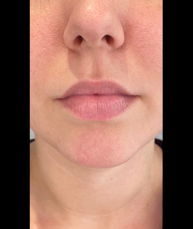 Fillers Before & After Gallery - Patient 108443274 - Image 1