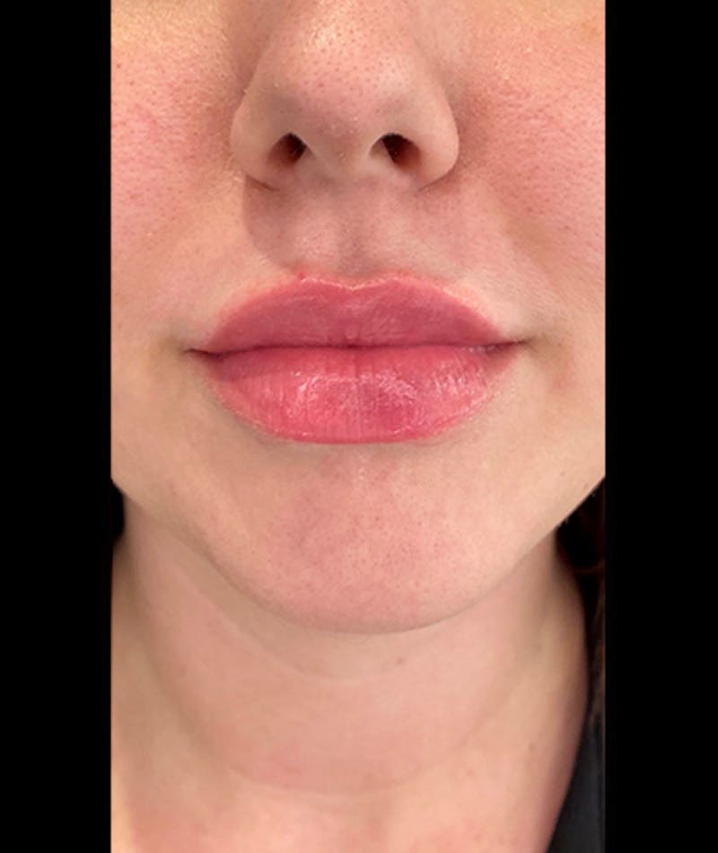 Fillers Before & After Gallery - Patient 108443274 - Image 2