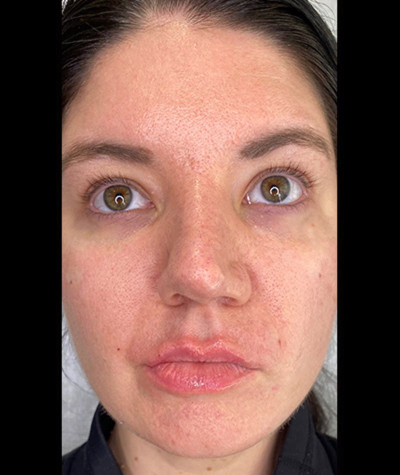 Fillers Before & After Gallery - Patient 108443276 - Image 2