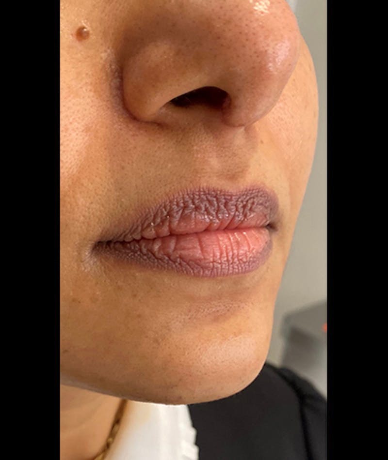 Fillers Before & After Gallery - Patient 108443311 - Image 1