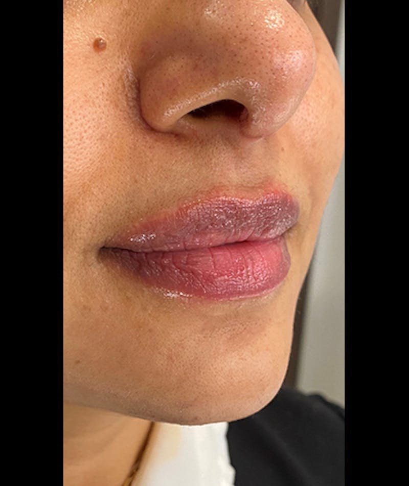 Fillers Before & After Gallery - Patient 108443311 - Image 2