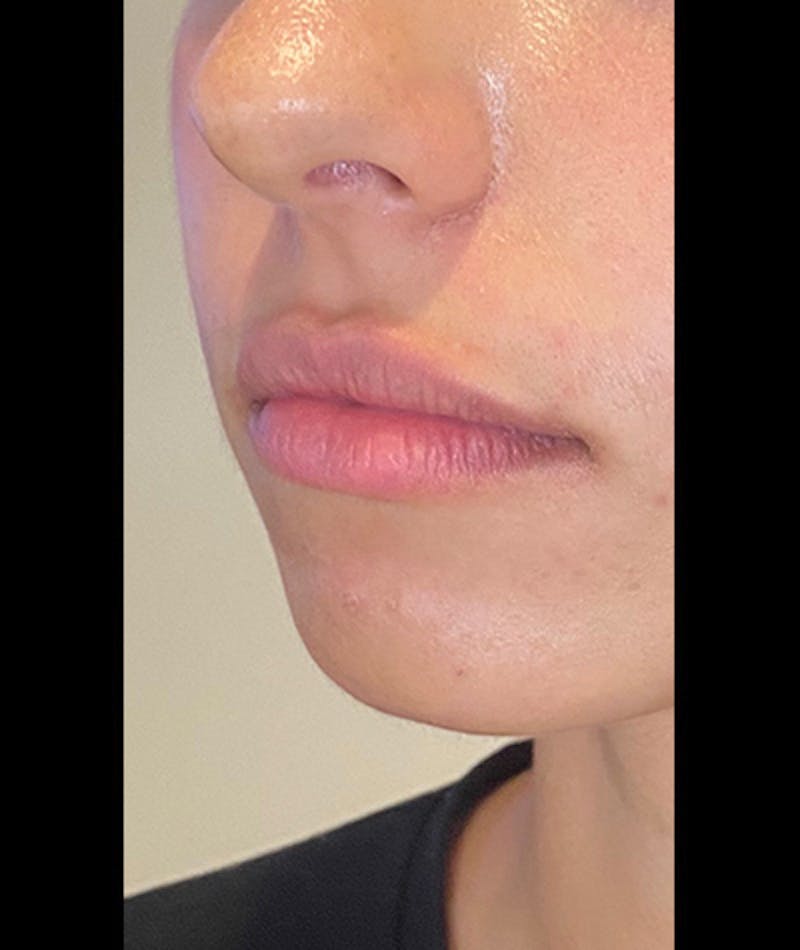 Fillers Before & After Gallery - Patient 108443318 - Image 1