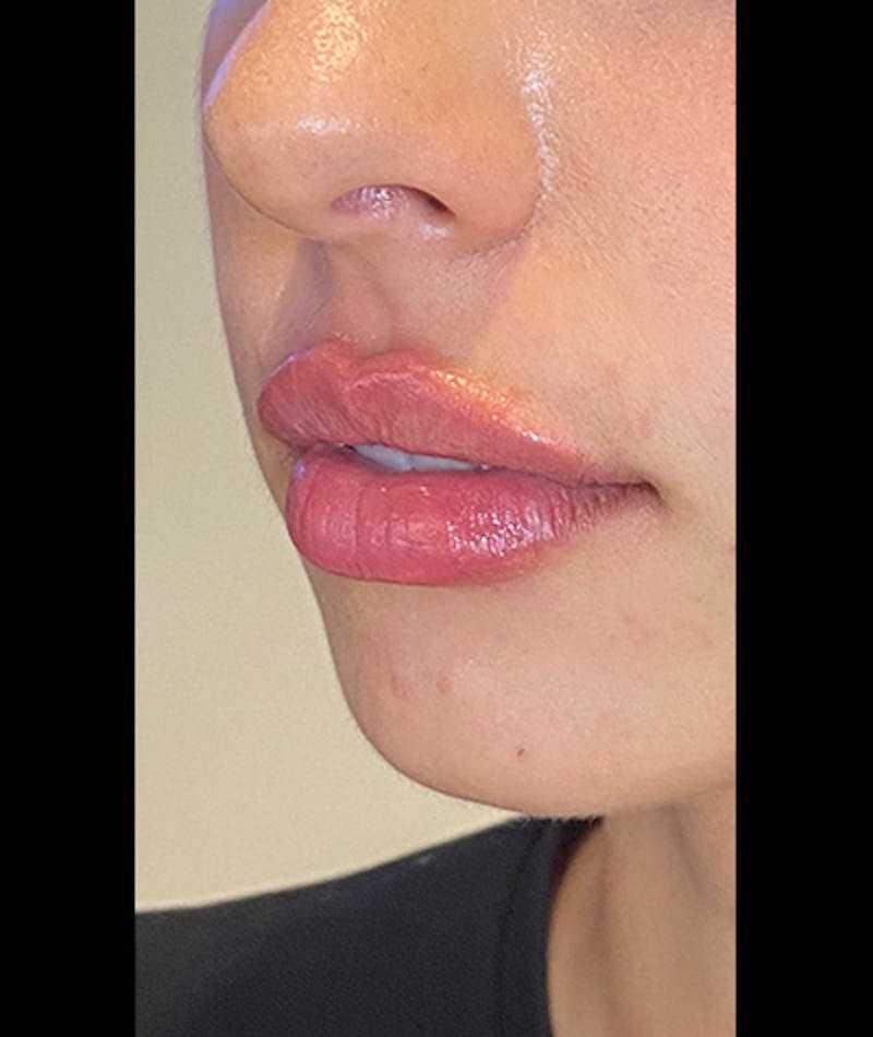 Fillers Before & After Gallery - Patient 108443318 - Image 2