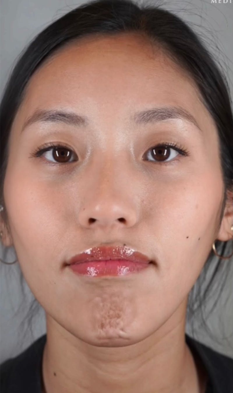 BOTOX Before & After Gallery - Patient 123774557 - Image 1