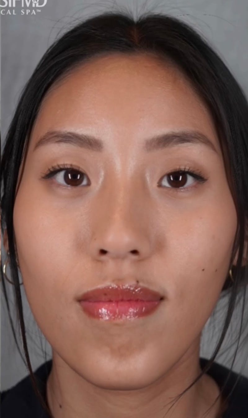 BOTOX Before & After Gallery - Patient 123774557 - Image 2