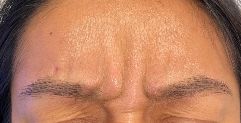 BOTOX Before & After Gallery - Patient 123774555 - Image 1