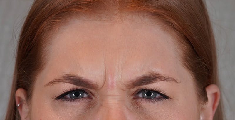 BOTOX Before & After Gallery - Patient 123774556 - Image 3