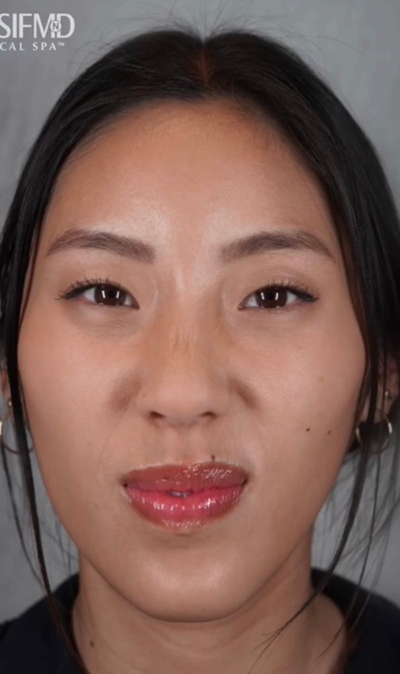 BOTOX Before & After Gallery - Patient 123774557 - Image 4