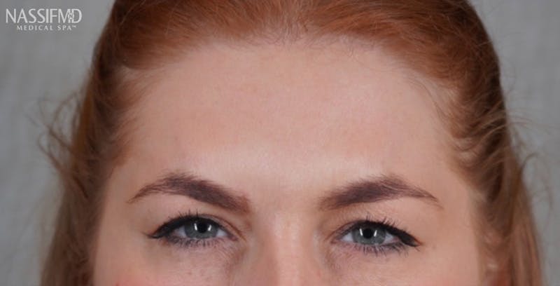 BOTOX Before & After Gallery - Patient 123774556 - Image 4