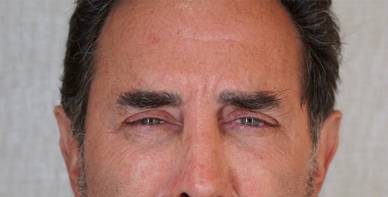 BOTOX Before & After Gallery - Patient 123774554 - Image 1