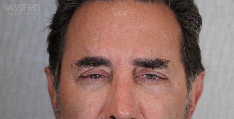 BOTOX Before & After Gallery - Patient 123774554 - Image 2