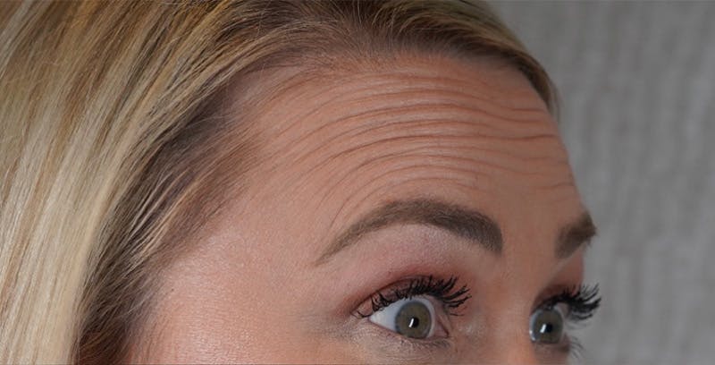 BOTOX Before & After Gallery - Patient 123774553 - Image 1