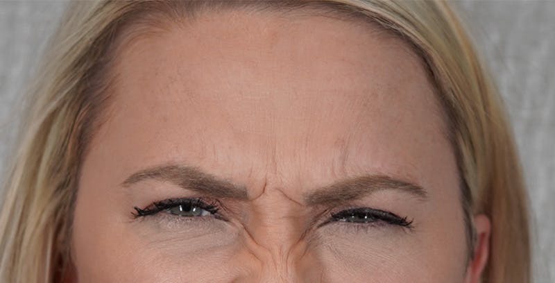 BOTOX Before & After Gallery - Patient 123774553 - Image 3