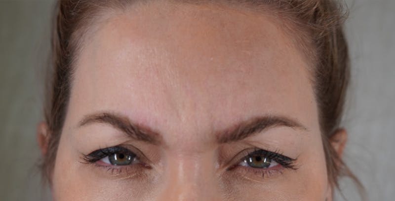 BOTOX Before & After Gallery - Patient 123774552 - Image 1