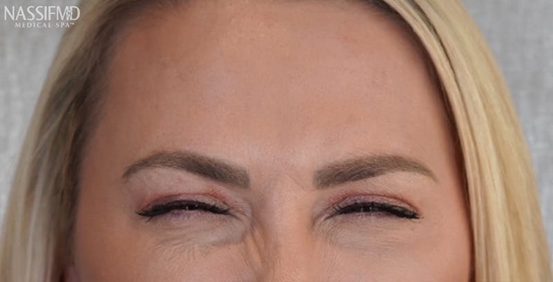 BOTOX Before & After Gallery - Patient 123774553 - Image 4