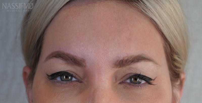 BOTOX Before & After Gallery - Patient 123774552 - Image 2