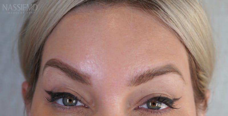 BOTOX Before & After Gallery - Patient 123774552 - Image 4