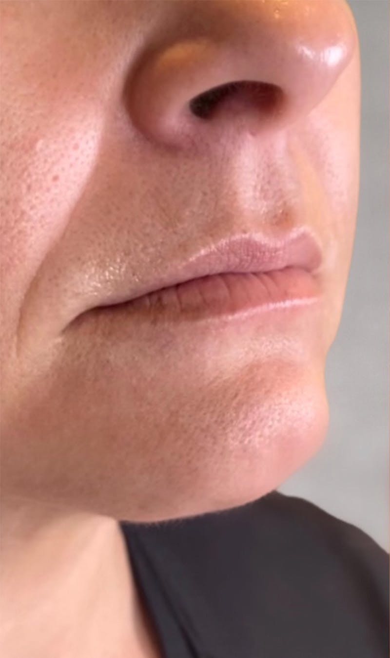 Fillers Before & After Gallery - Patient 123774580 - Image 1
