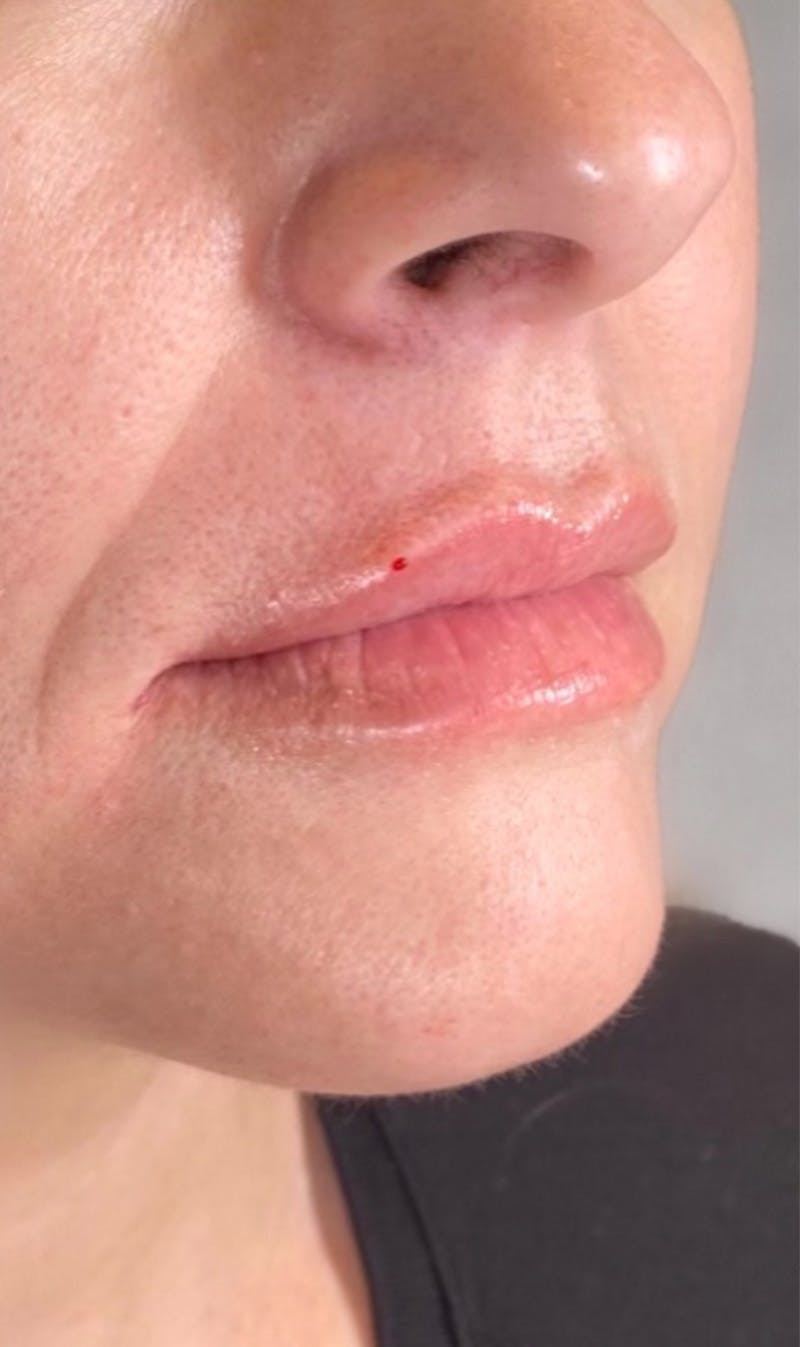 Fillers Before & After Gallery - Patient 123774580 - Image 2