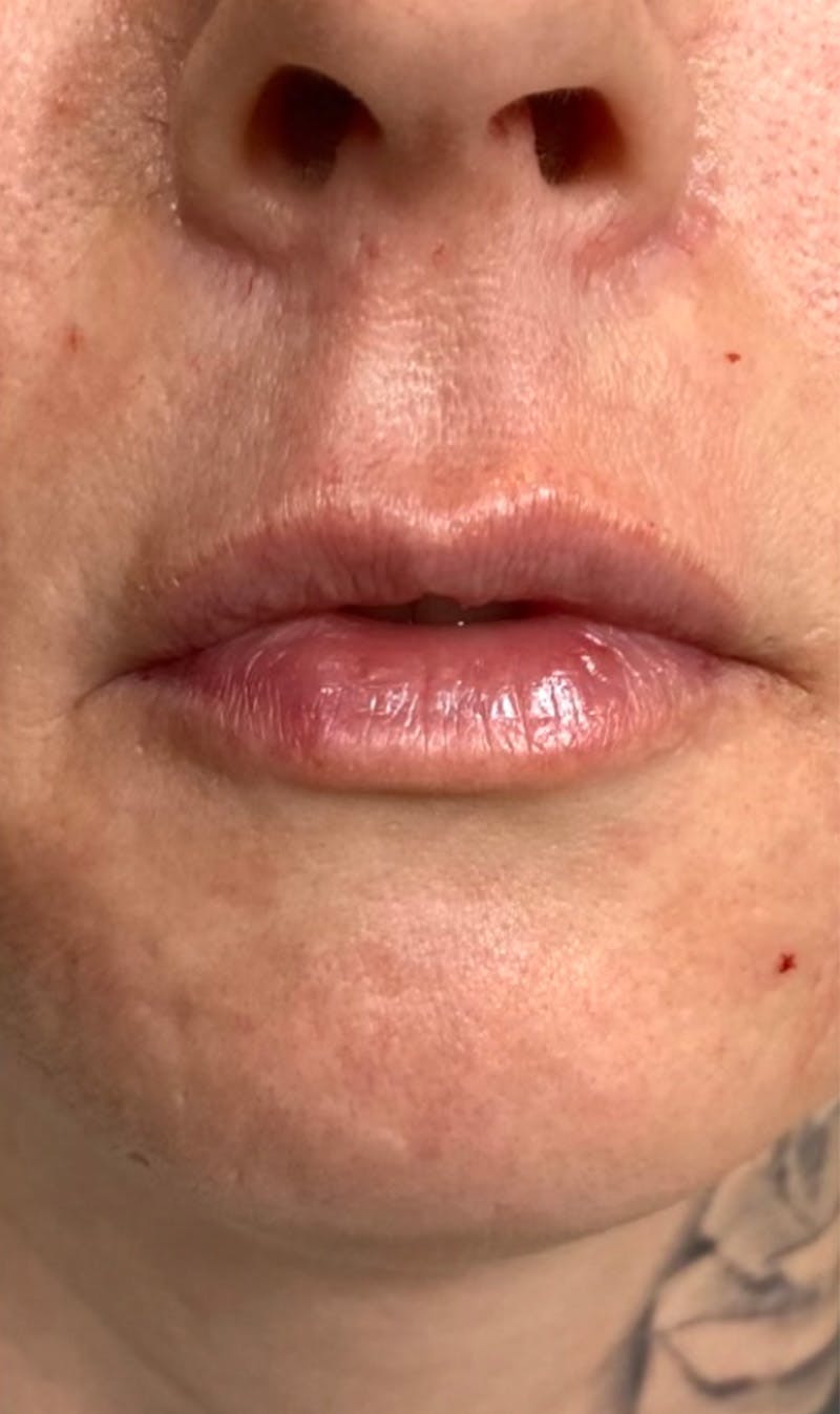 Fillers Before & After Gallery - Patient 123774579 - Image 2