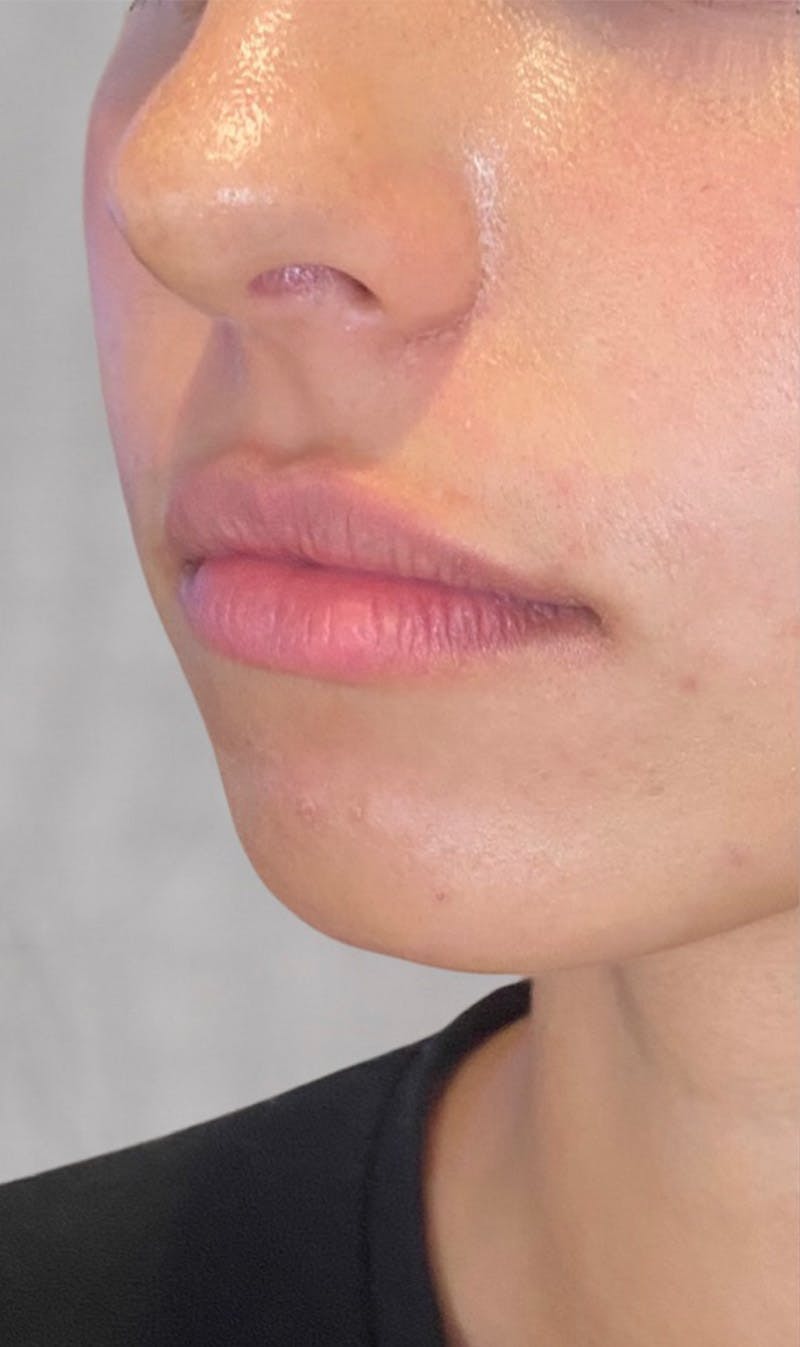 Fillers Before & After Gallery - Patient 123774578 - Image 1