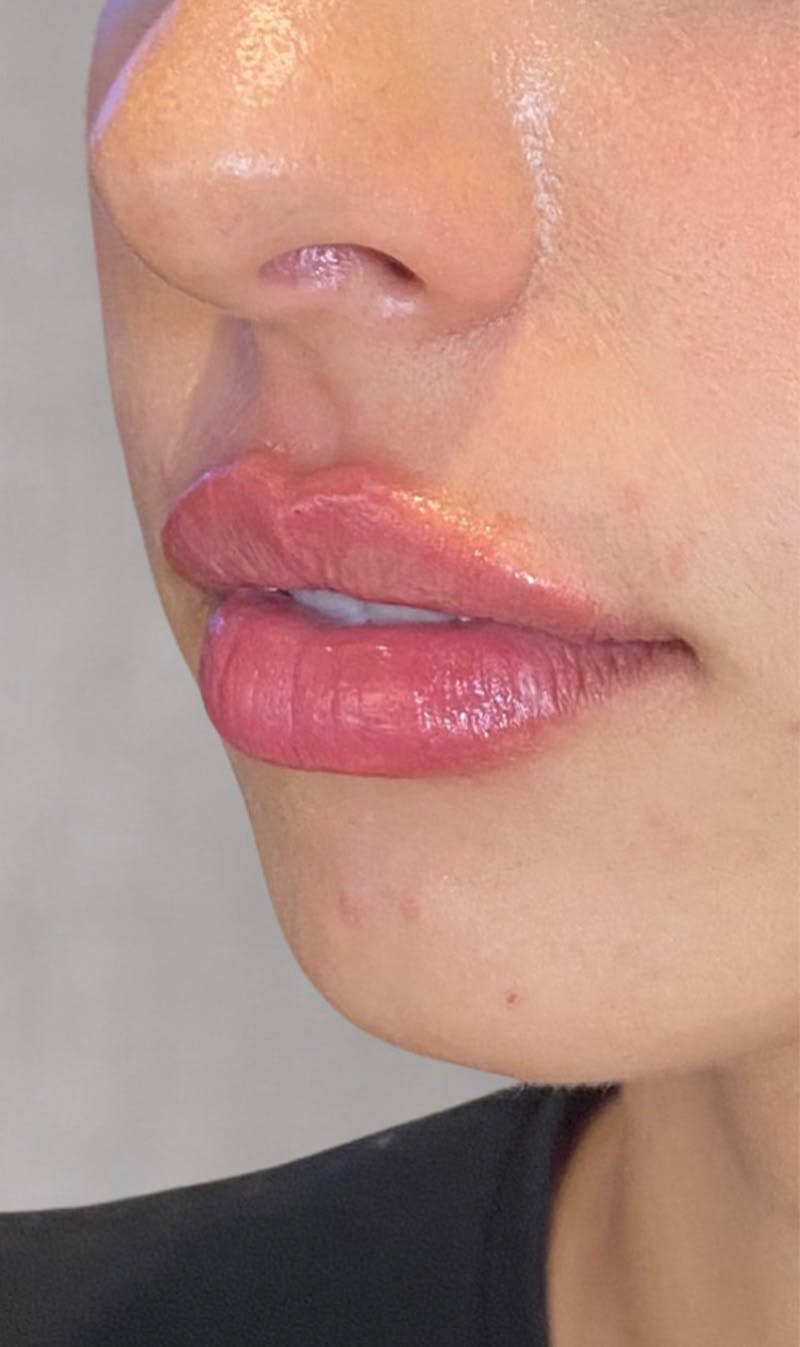 Fillers Before & After Gallery - Patient 123774578 - Image 2