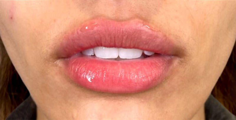 Fillers Before & After Gallery - Patient 123774577 - Image 2