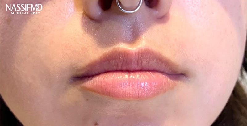 Fillers Before & After Gallery - Patient 123774575 - Image 1