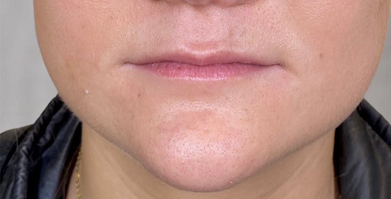 Fillers Before & After Gallery - Patient 123774574 - Image 1