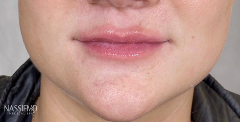 Fillers Before & After Gallery - Patient 123774574 - Image 2