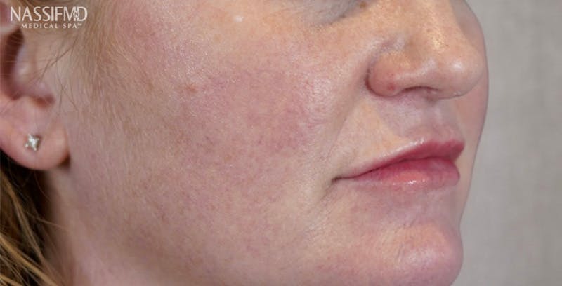Fillers Before & After Gallery - Patient 123774573 - Image 2