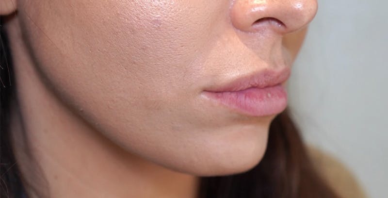 Fillers Before & After Gallery - Patient 123774572 - Image 1