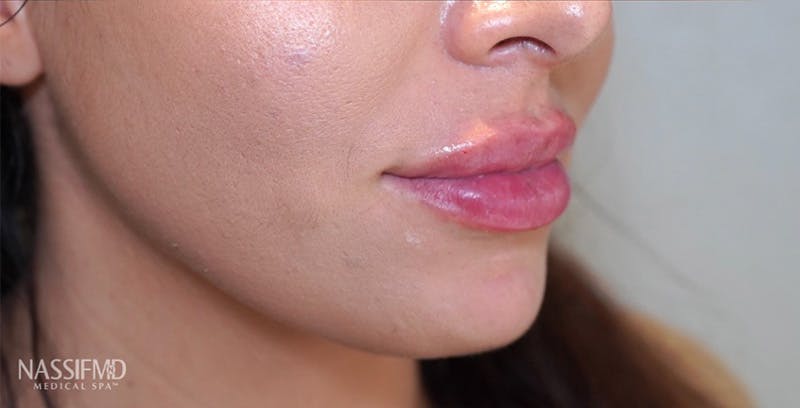 Fillers Before & After Gallery - Patient 123774572 - Image 2