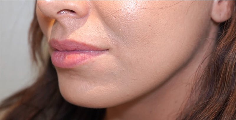 Fillers Before & After Gallery - Patient 123774572 - Image 3