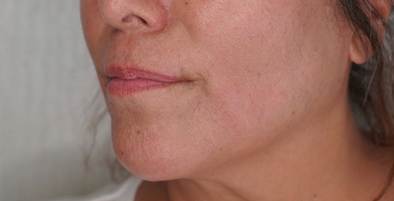 Fillers Before & After Gallery - Patient 123774571 - Image 1