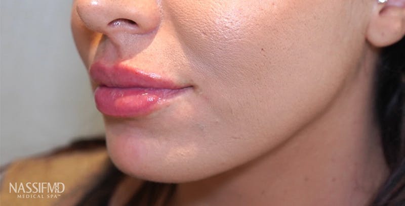 Fillers Before & After Gallery - Patient 123774572 - Image 4
