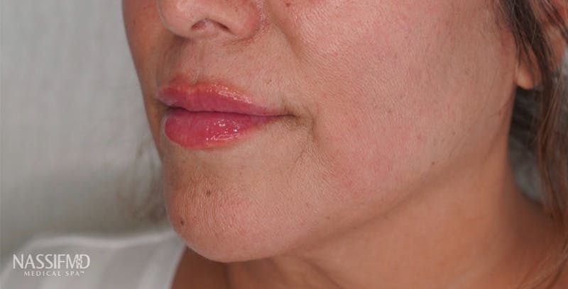Fillers Before & After Gallery - Patient 123774571 - Image 2