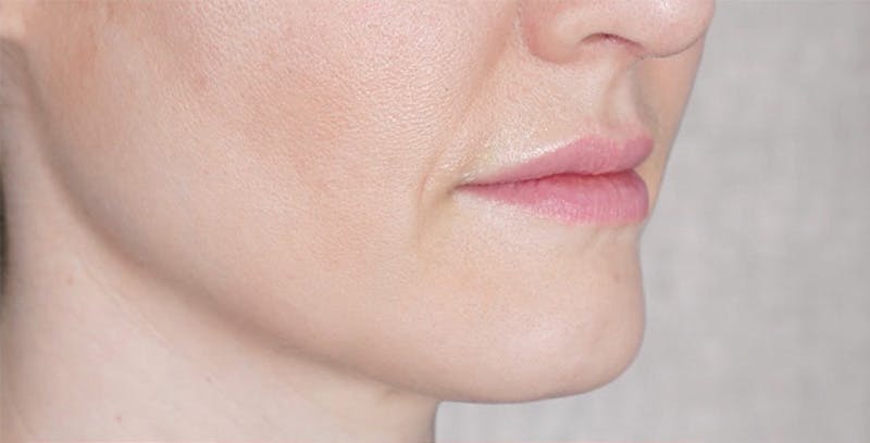 Fillers Before & After Gallery - Patient 123774570 - Image 1