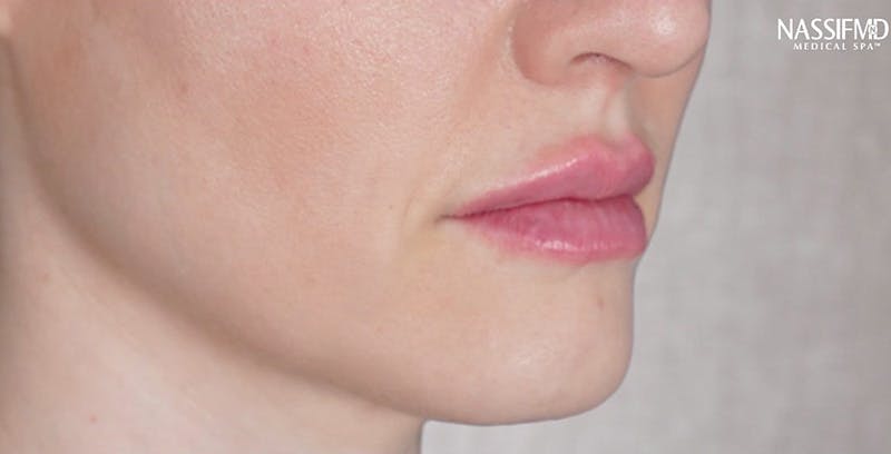 Fillers Before & After Gallery - Patient 123774570 - Image 2