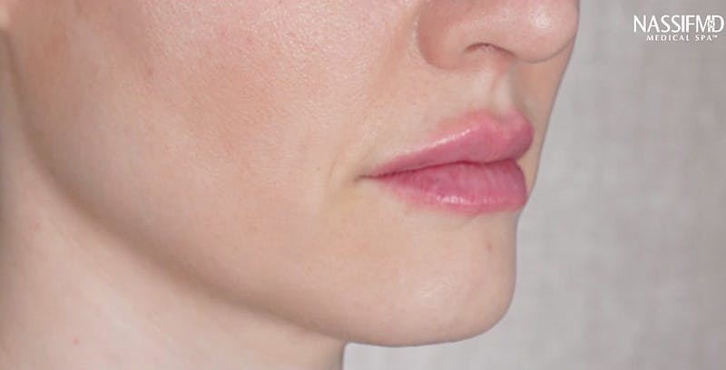 LIP FILLER GALLERY - Heavenly Plastic Surgery