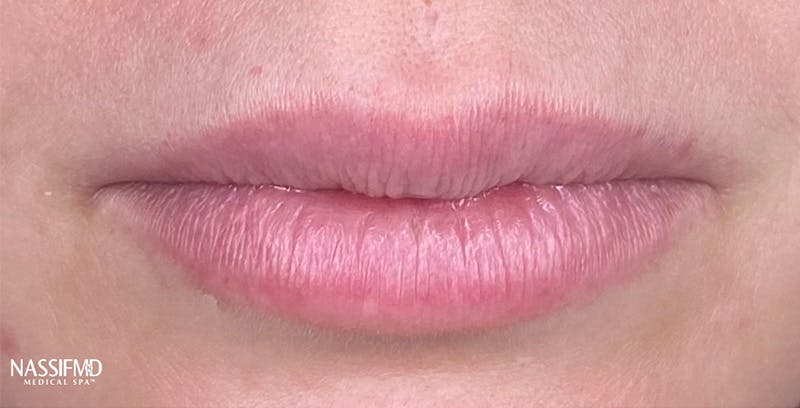 Fillers Before & After Gallery - Patient 123774569 - Image 1